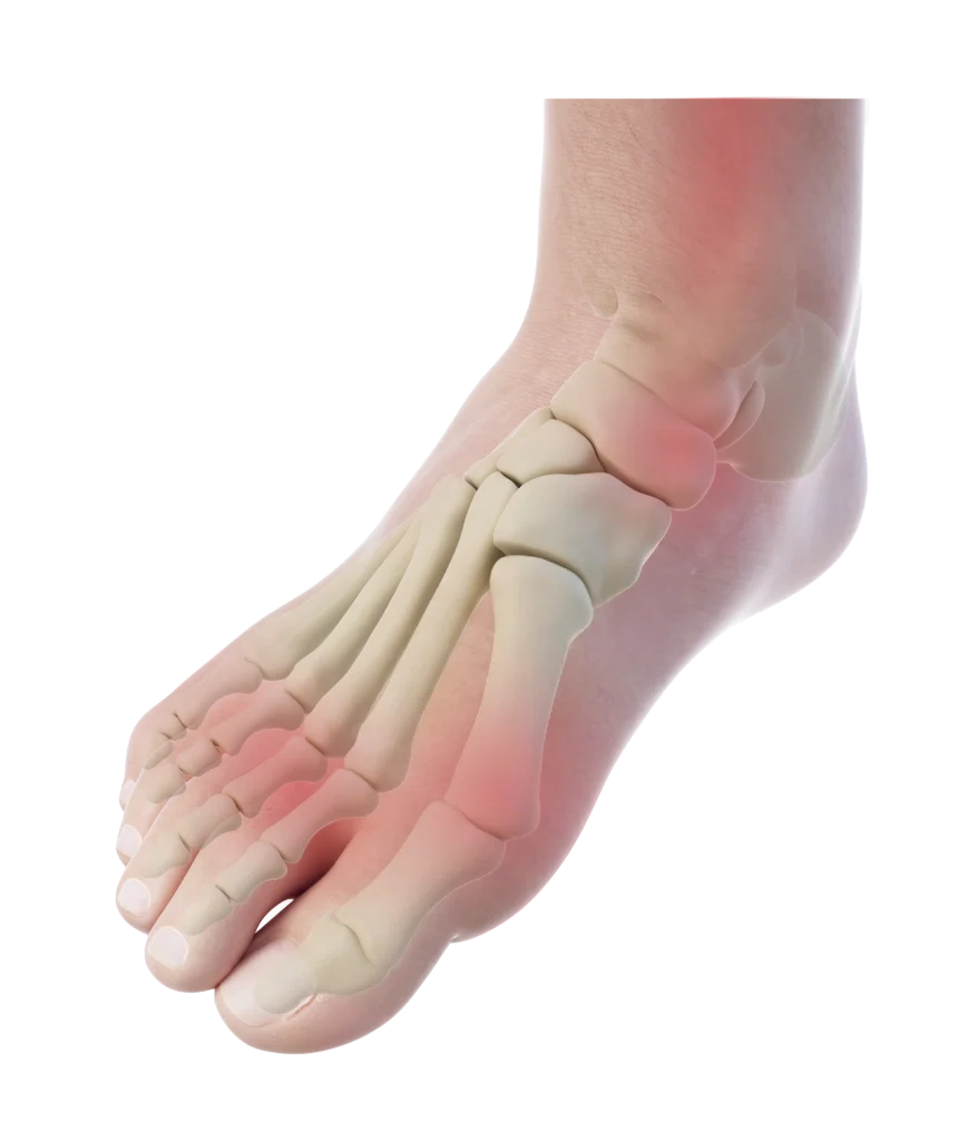 Sports Injuries
