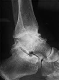 Arthritis