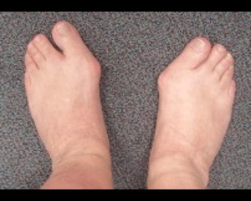 Bunions & Toe Deformities