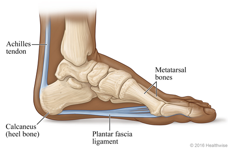 Heel Pain