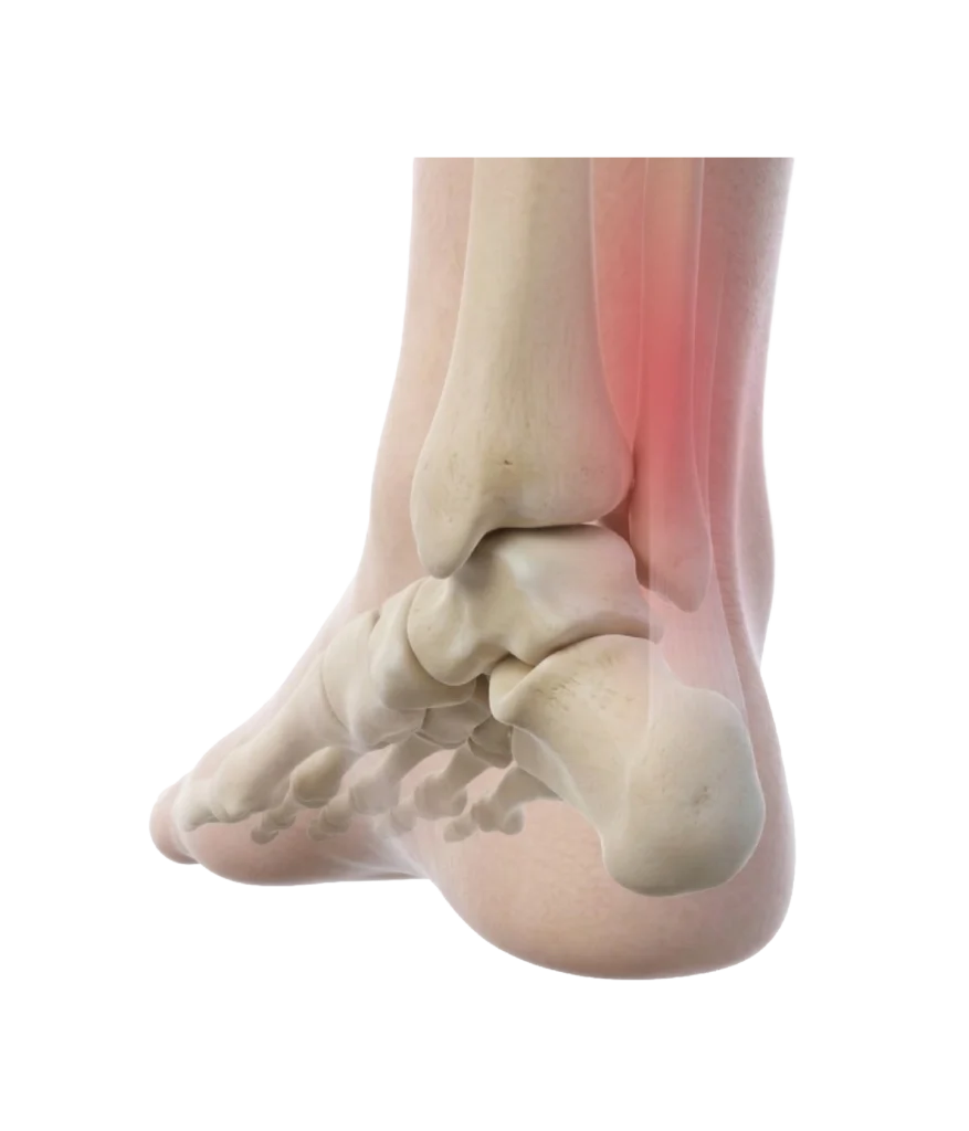 Achilles Tendon